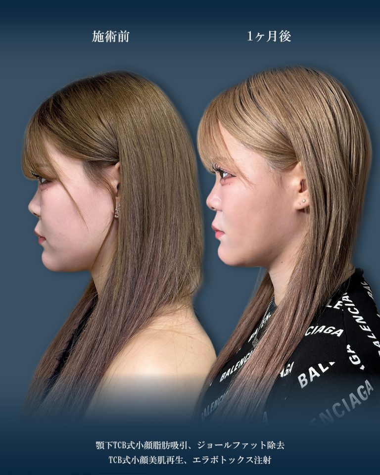 顔の脂肪吸引(担当医:大見 貴秀 医師)の症例写真2