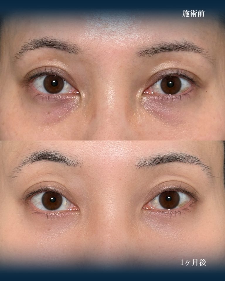 切らない目の下のクマ取り・目の下のたるみ（ふくらみ）取り(担当医:大見 貴秀 医師)の症例写真1