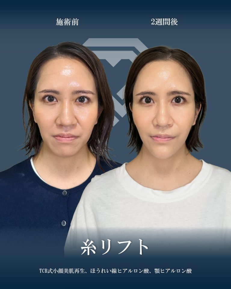 小顔美肌再生（リフトアップ）(担当医:大見 貴秀 医師)の症例写真1