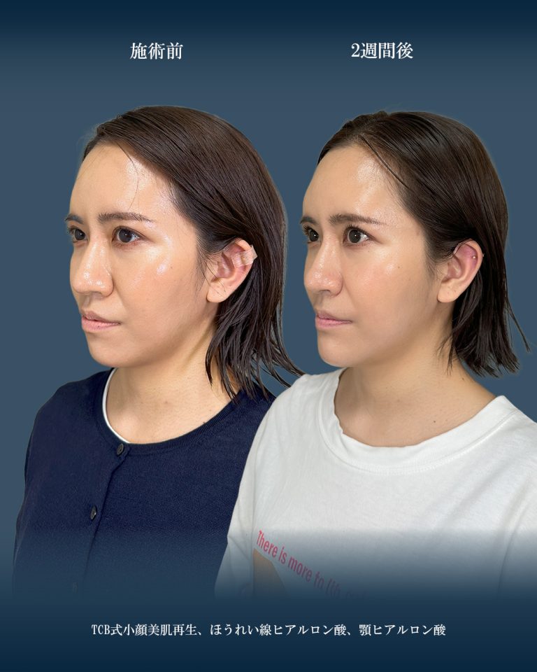 小顔美肌再生（リフトアップ）(担当医:大見 貴秀 医師)の症例写真2