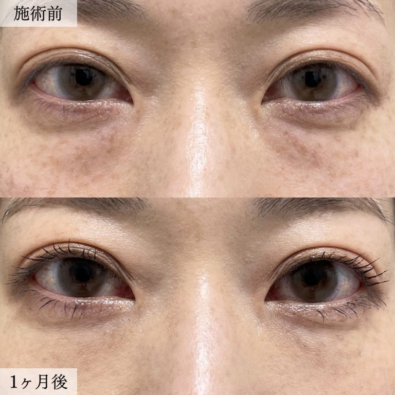 切らない目の下のクマ取り・目の下のたるみ（ふくらみ）取り(担当医:大見 貴秀 医師)の症例写真1