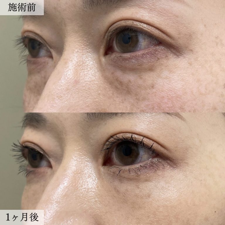 切らない目の下のクマ取り・目の下のたるみ（ふくらみ）取り(担当医:大見 貴秀 医師)の症例写真2