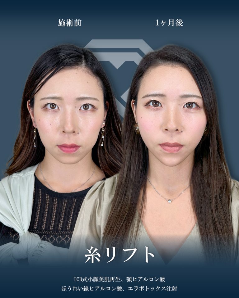 小顔美肌再生（リフトアップ）(担当医:大見 貴秀 医師)の症例写真1