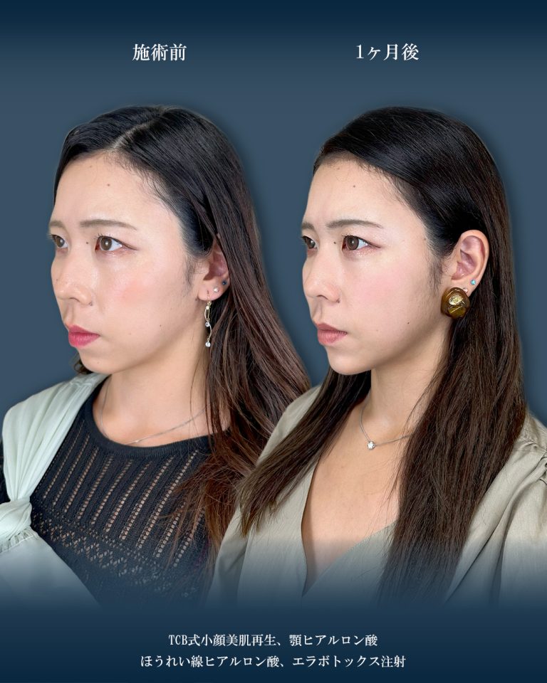 小顔美肌再生（リフトアップ）(担当医:大見 貴秀 医師)の症例写真2