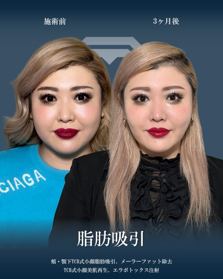 顔の脂肪吸引(担当医:大見 貴秀 医師)の症例写真1