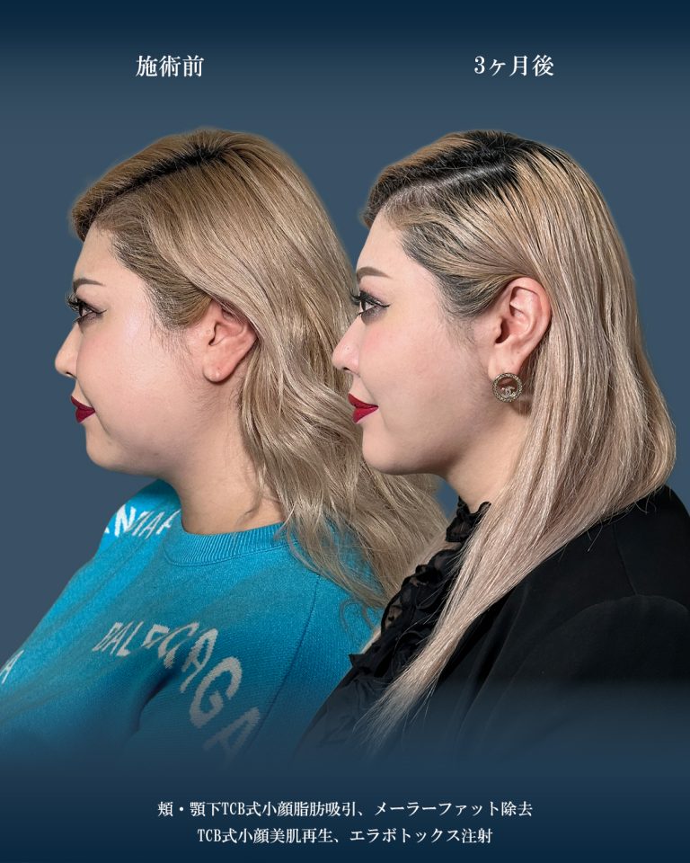 顔の脂肪吸引(担当医:大見 貴秀 医師)の症例写真2