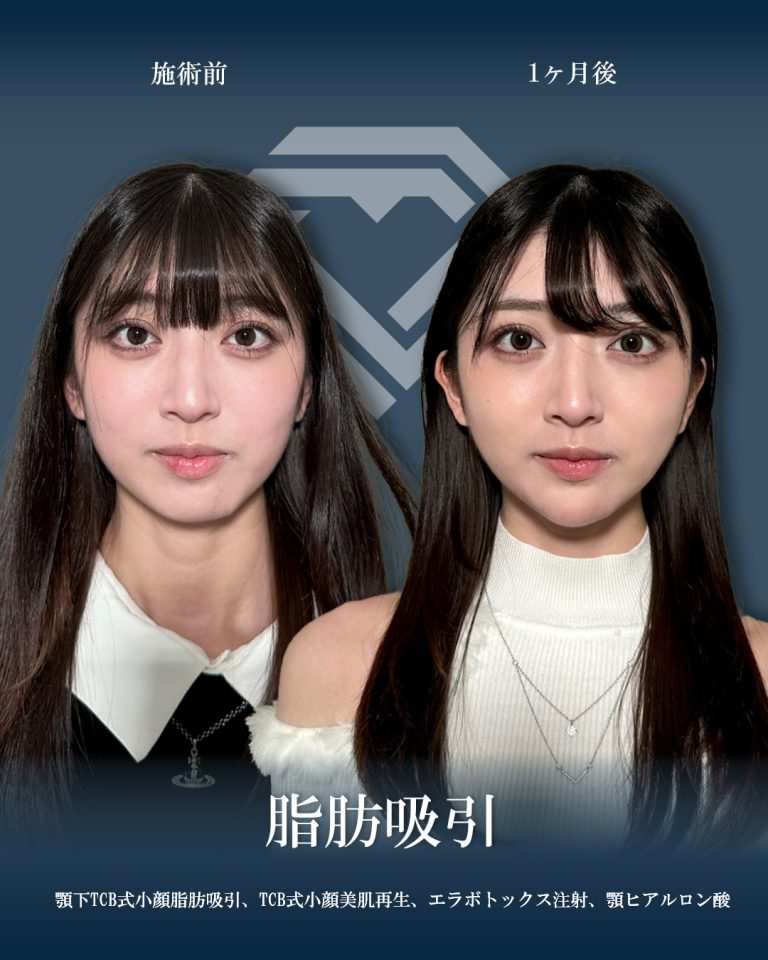 顔の脂肪吸引(担当医:大見 貴秀 医師)の症例写真1