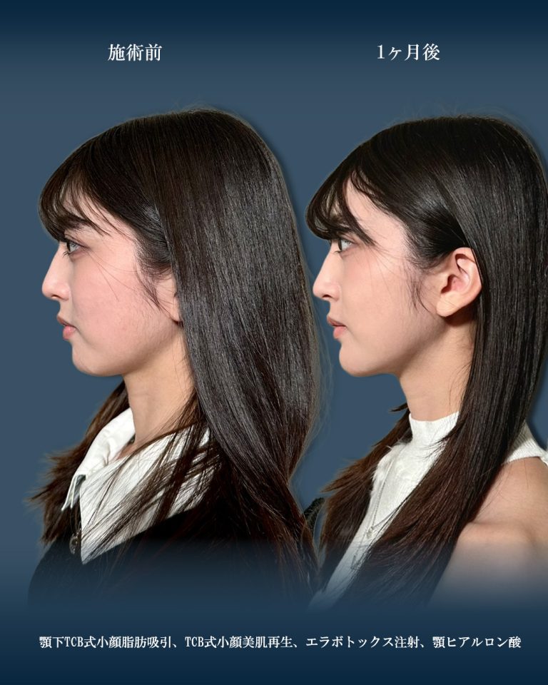 顔の脂肪吸引(担当医:大見 貴秀 医師)の症例写真2