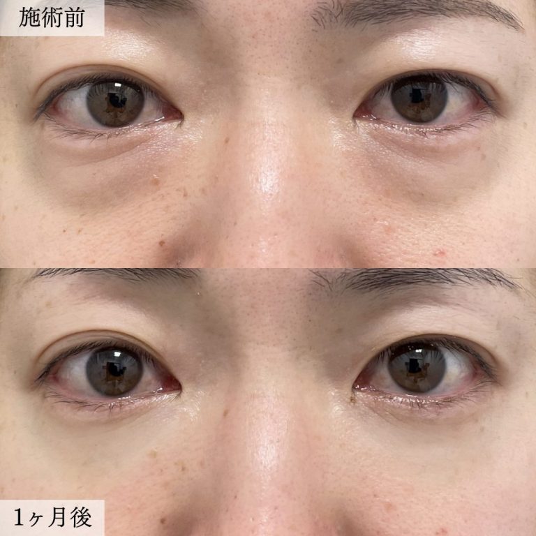 切らない目の下のクマ取り・目の下のたるみ（ふくらみ）取り(担当医:大見 貴秀 医師)の症例写真1