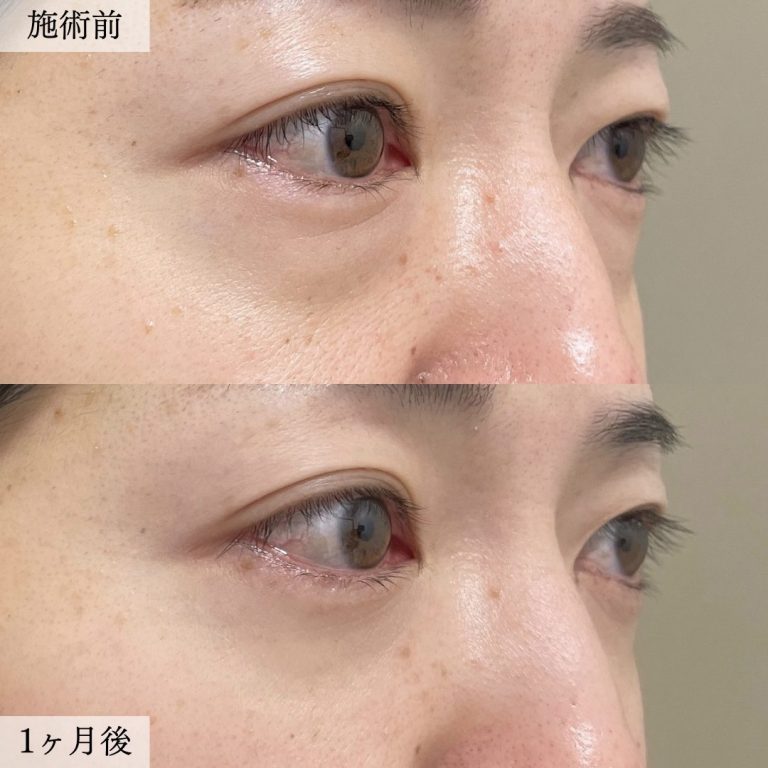 切らない目の下のクマ取り・目の下のたるみ（ふくらみ）取り(担当医:大見 貴秀 医師)の症例写真2