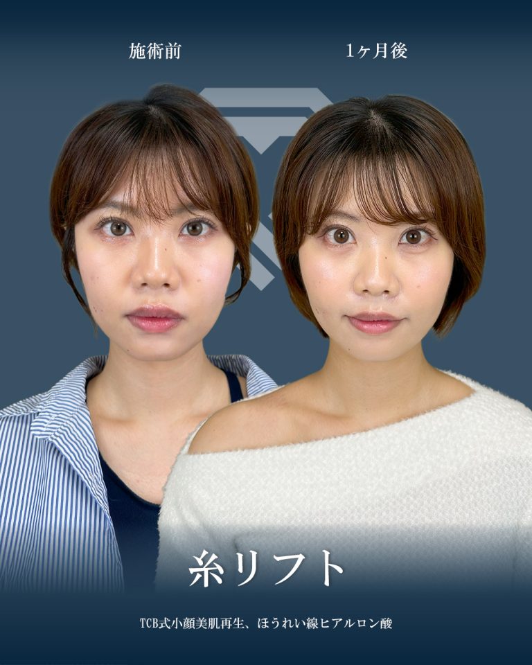 小顔美肌再生（リフトアップ）(担当医:大見 貴秀 医師)の症例写真1