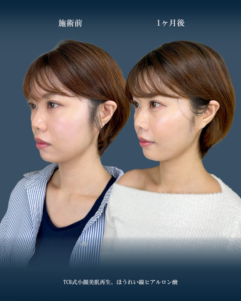 小顔美肌再生（リフトアップ）(担当医:大見 貴秀 医師)の症例写真2