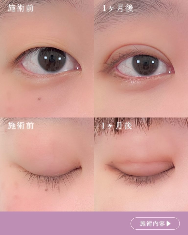 二重埋没法(担当医:村井 瑞佳 医師)の症例写真1