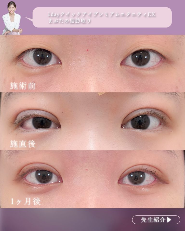 二重埋没法(担当医:村井 瑞佳 医師)の症例写真2