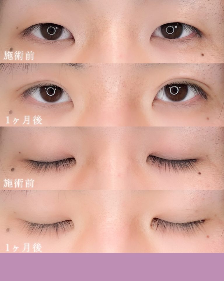 二重埋没法(担当医:村井 瑞佳 医師)の症例写真2